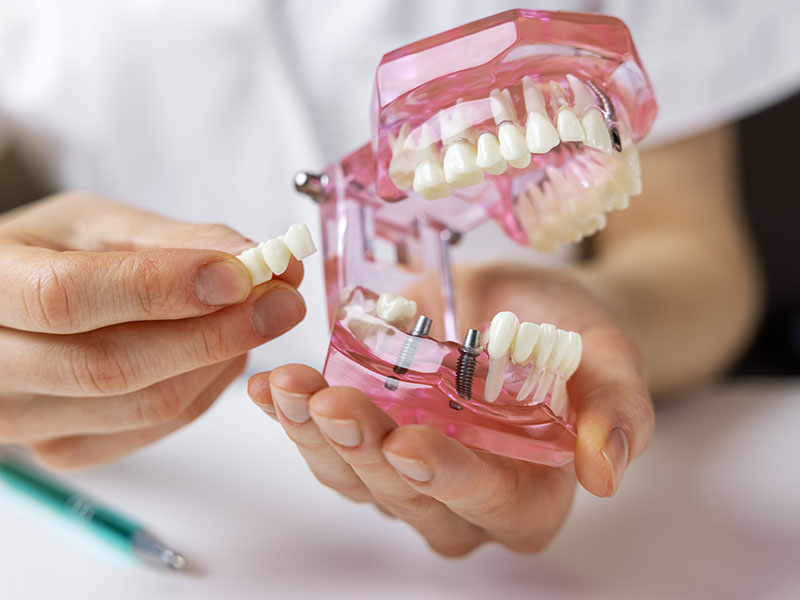 A person holding a model mouth with teeth, showcasing dental implants or dentures, while seated at a table.